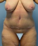tummy tuck patient