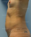 tummy tuck patient