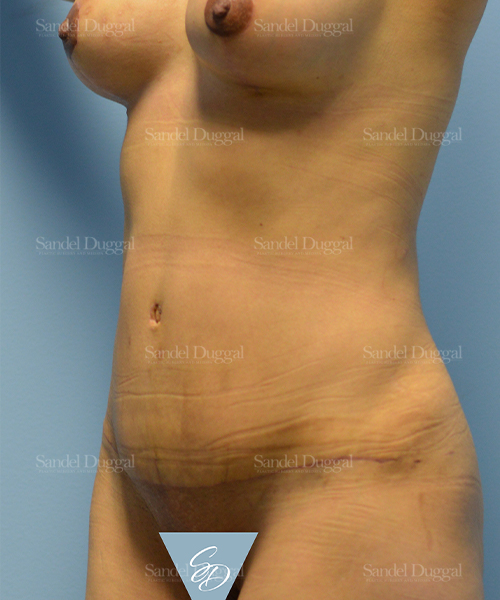 tummy tuck patient