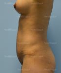 tummy tuck patient