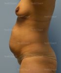 tummy tuck patient