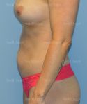 tummy tuck patient