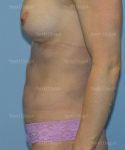 tummy tuck patient