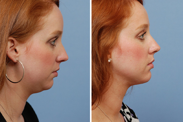 Neck & Chin Liposuction Annapolis, MD | Sandel Duggal Plastic Surgery