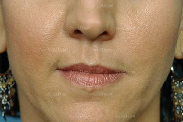 botox / fillers patient
