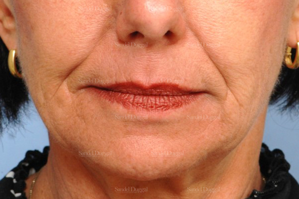 botox / fillers patient