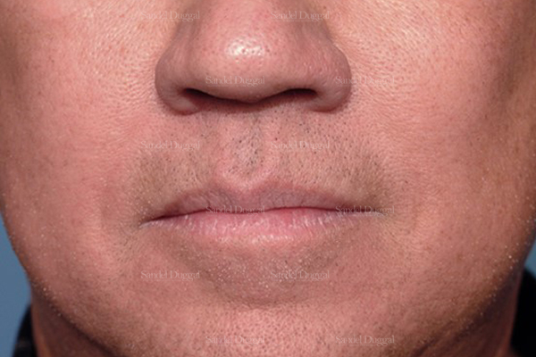 botox / fillers patient