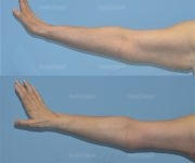 brachioplasty before and after
