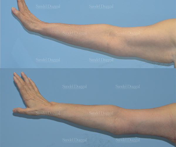 brachioplasty before and after