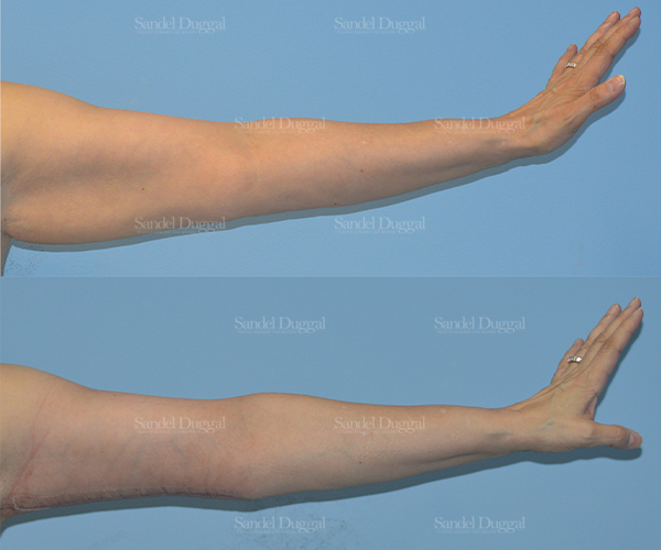 brachioplasty before and after