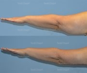 brachioplasty before and after
