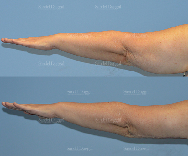 brachioplasty before and after
