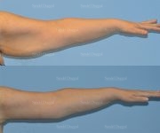brachioplasty before and after