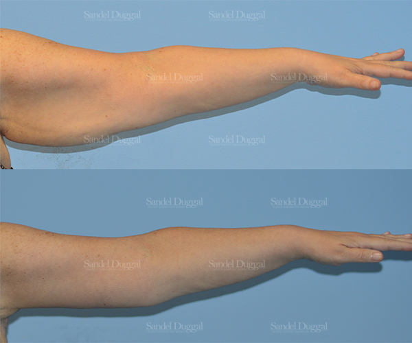 brachioplasty before and after