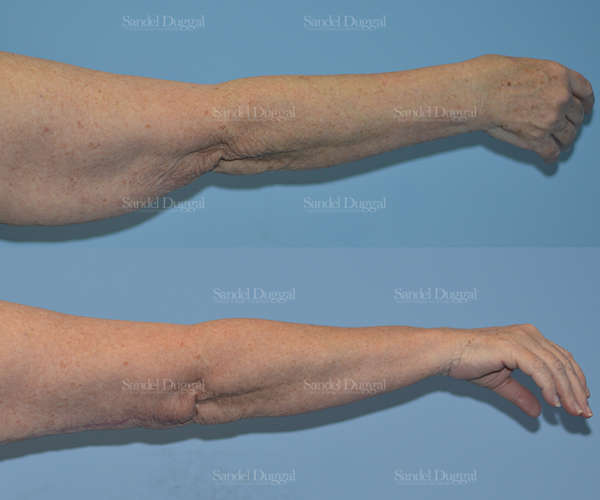 brachioplasty before and after