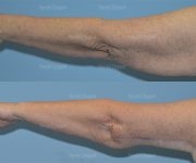 brachioplasty before and after