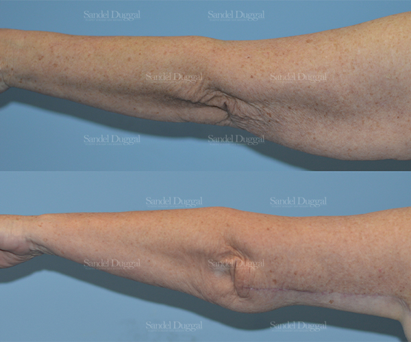 brachioplasty before and after