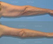 brachioplasty before and after