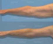 brachioplasty before and after