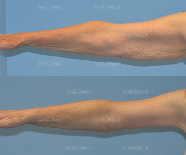 brachioplasty before and after