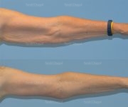 brachioplasty before and after
