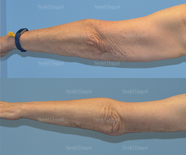 brachioplasty before and after