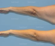 brachioplasty before and after
