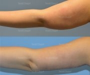 brachioplasty before and after