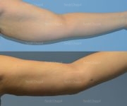 brachioplasty before and after