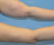 brachioplasty before and after