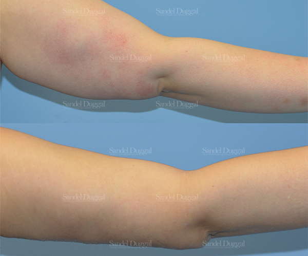 brachioplasty before and after