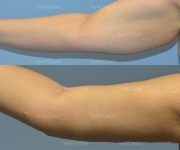brachioplasty before and after