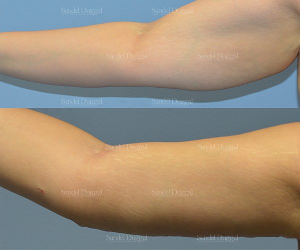 brachioplasty before and after