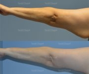 brachioplasty before and after