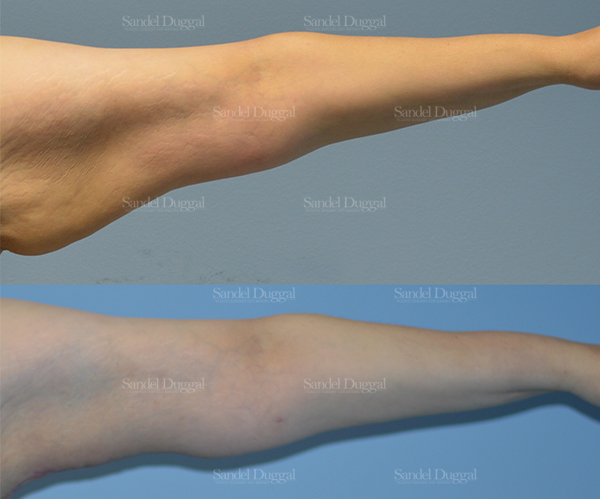 brachioplasty before and after
