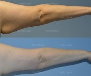 brachioplasty before and after