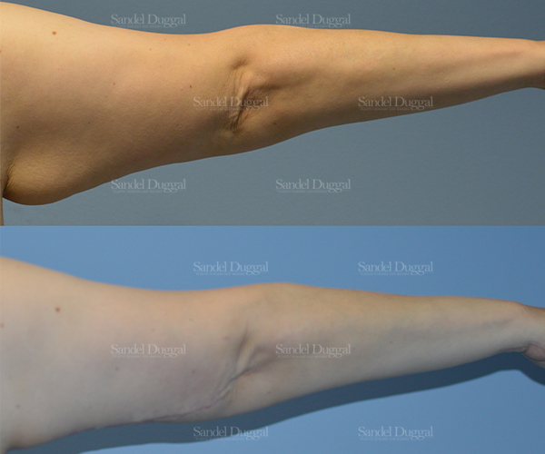 brachioplasty before and after