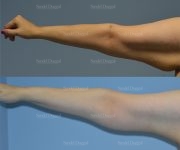 brachioplasty before and after