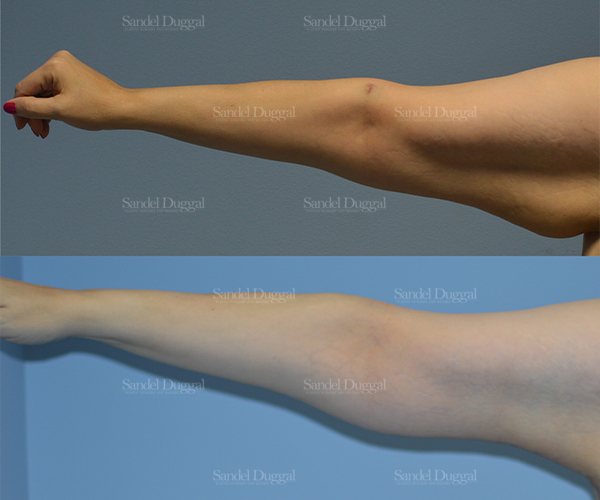 brachioplasty before and after