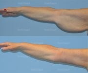 brachioplasty before and after