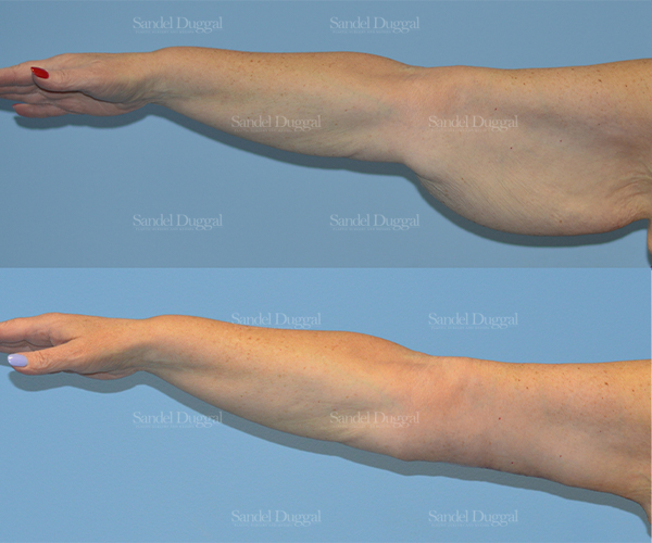 brachioplasty before and after