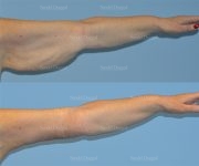 brachioplasty before and after