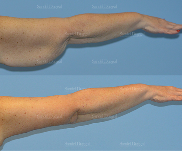 brachioplasty before and after