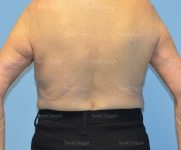 brachioplasty patient