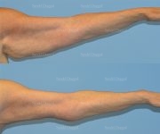 brachioplasty before and after