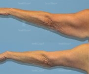 brachioplasty before and after