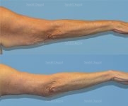 brachioplasty before and after