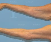 brachioplasty before and after