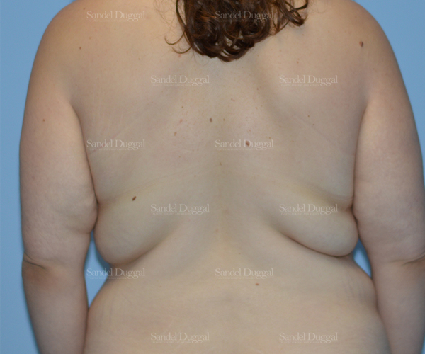 brachioplasty patient