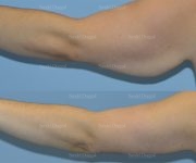 brachioplasty before and after